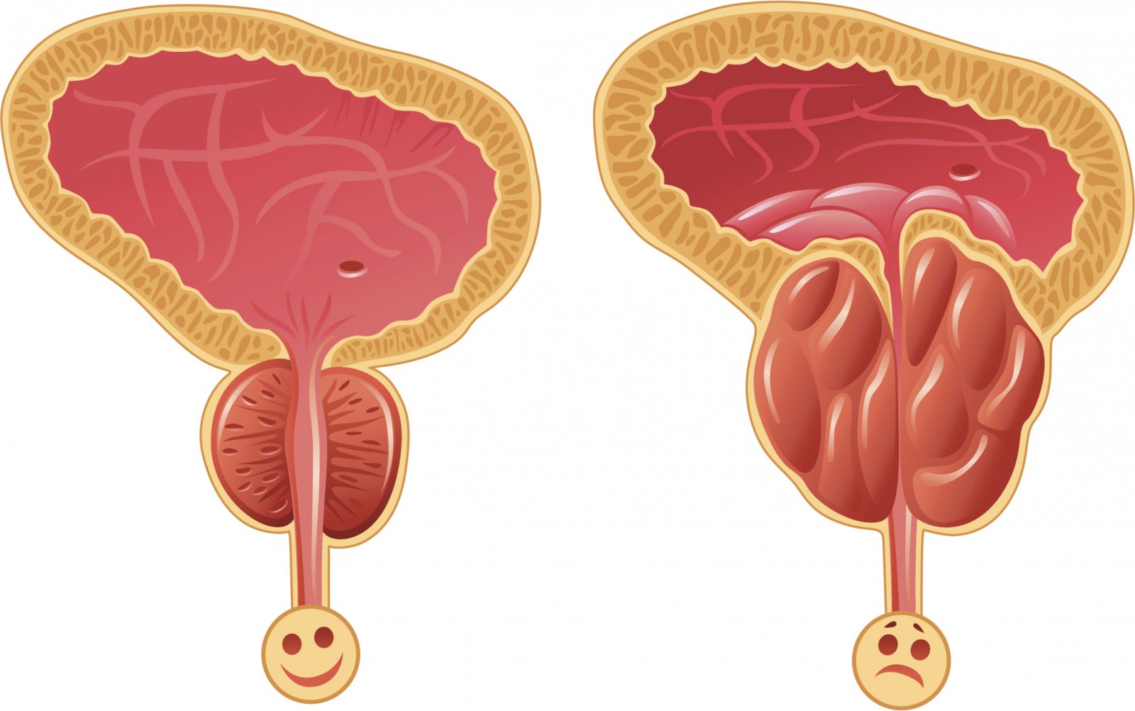 Prostatitis - an acute inflammatory process in the prostate gland