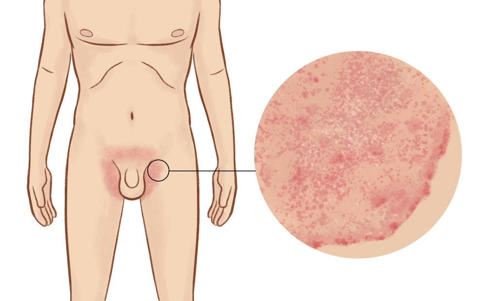 Раздражающий дерматит половых органов — причины, симптомы и лечение