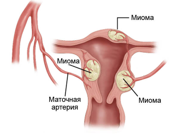 Симптомы воспаления органов малого таза у женщин