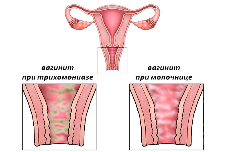 Признаки бактериального вагинита
