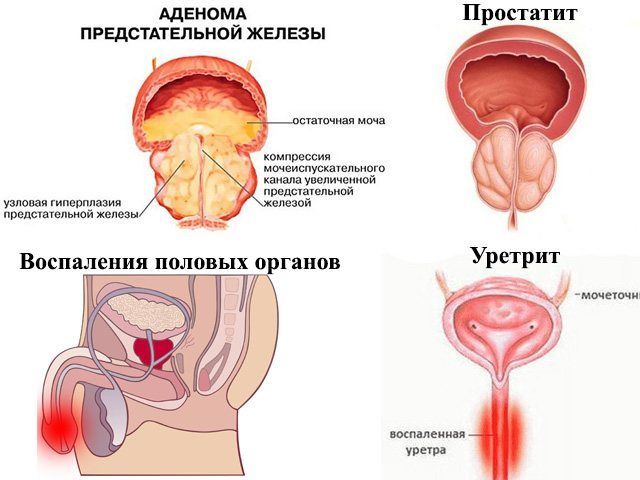 prostatit urertrit w)