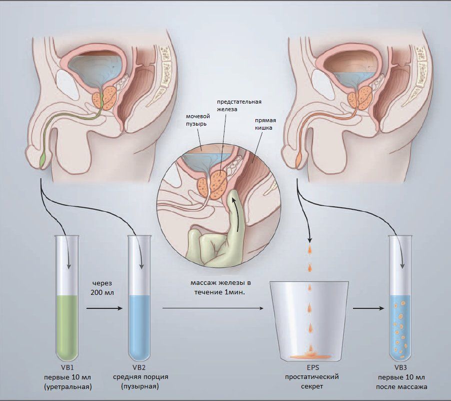 ureoplasma ca cauza a prostatitei tratament natural infectie urinara