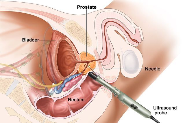 Biopsie prostata