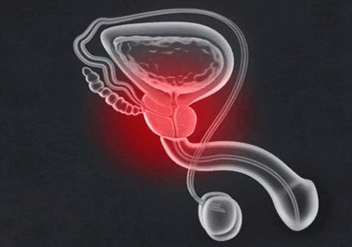 Простатит: причины, симптомы и лечение