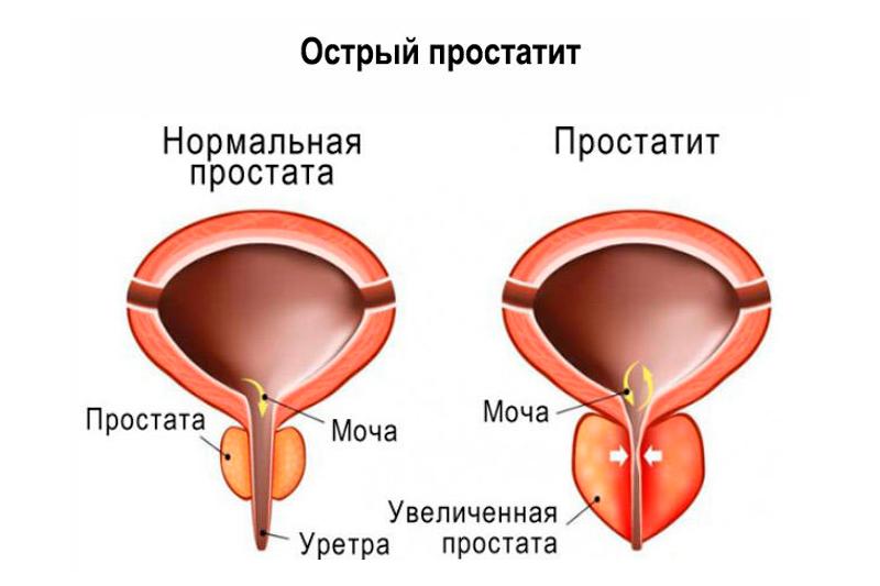 prostată sau prostatita